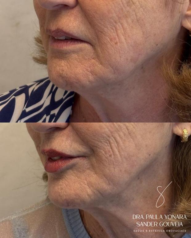 Antes e depois de abordagem integrada