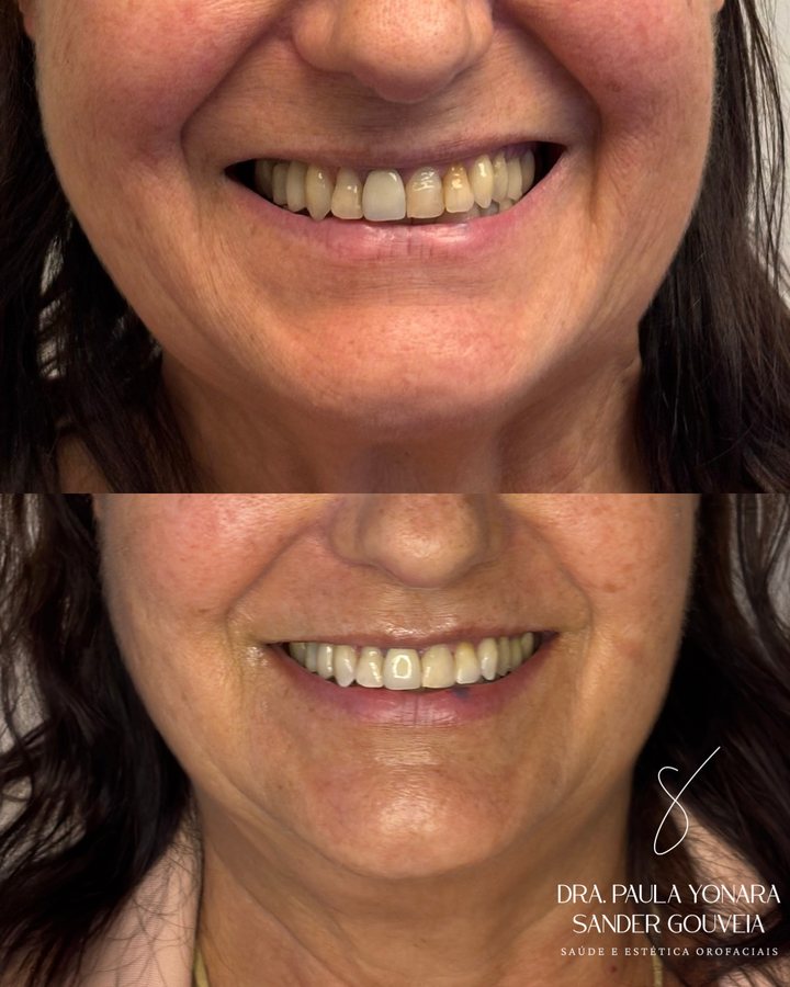 Antes e depois de clareamento dental feito pela Dra. Paula Gouveia em Paulínia