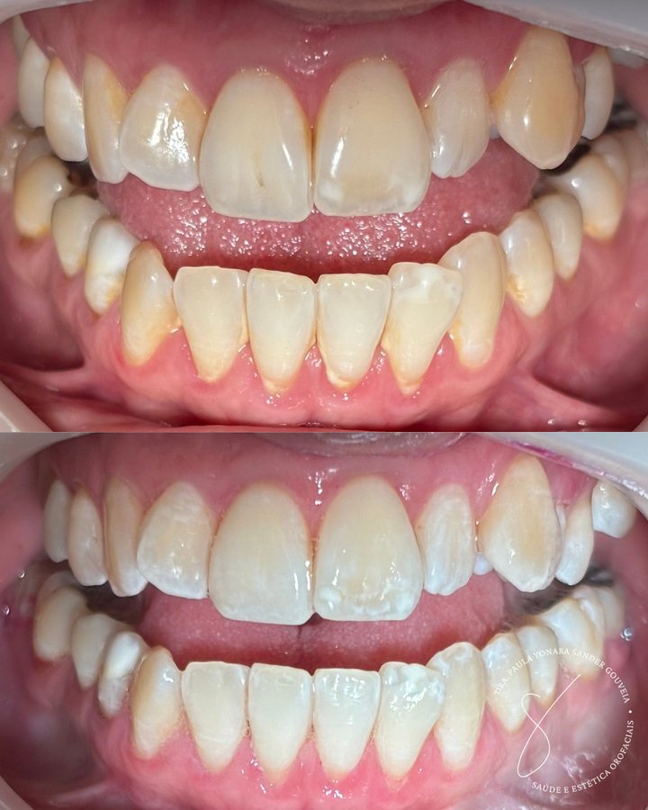 Antes e depois de clareamento dental em Paulínia, caso 2 da Dra. Paula Gouveia