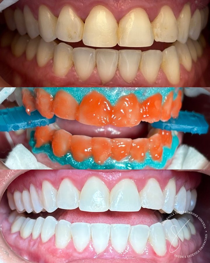 Antes e depois de clareamento dental em Paulínia, caso 3 da Dra. Paula Gouveia