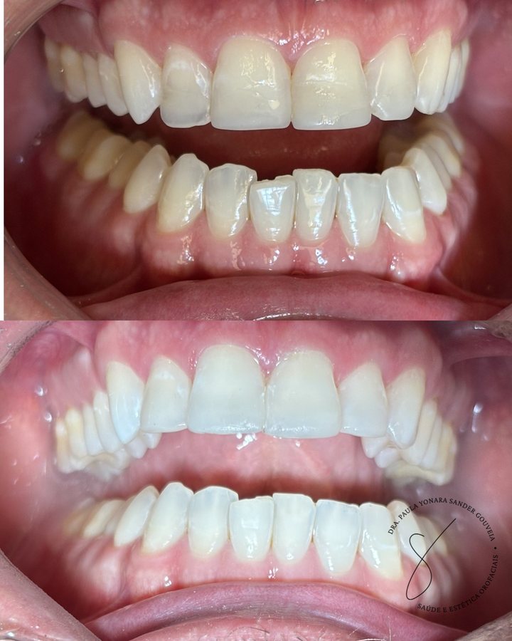 Antes e depois de clareamento dental em Paulínia, caso 4 da Dra. Paula Gouveia