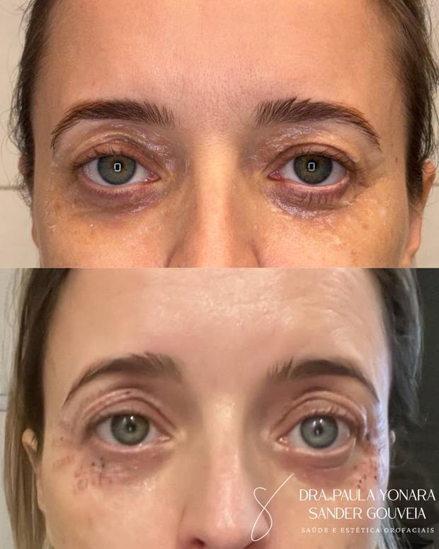 Antes e depois de jato de plasma