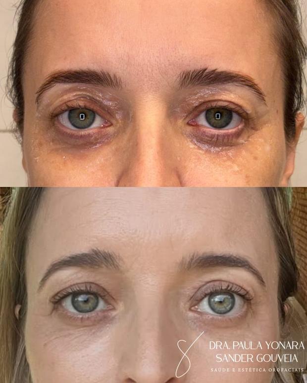 Antes e depois de jato de plasma