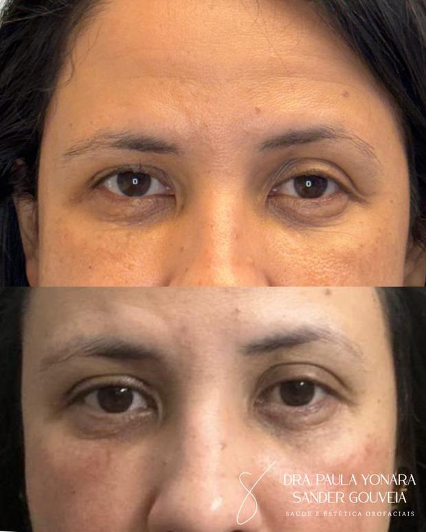 Antes e depois de jato de plasma