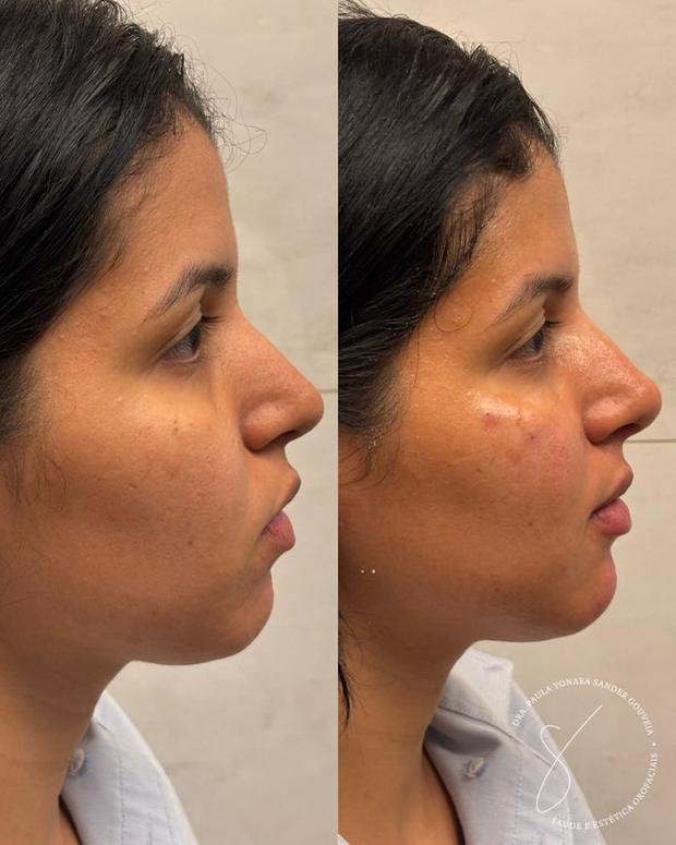 Antes e depois de perfiloplastia