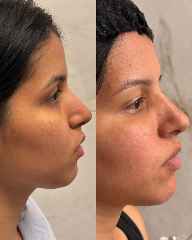 Antes e depois de perfiloplastia