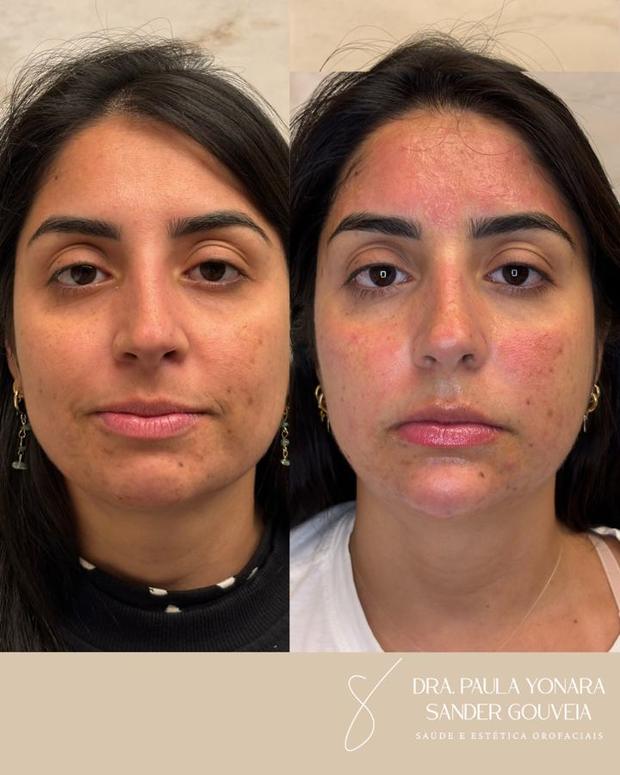 Antes e depois de perfiloplastia