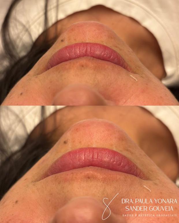 Antes e depois de perfiloplastia
