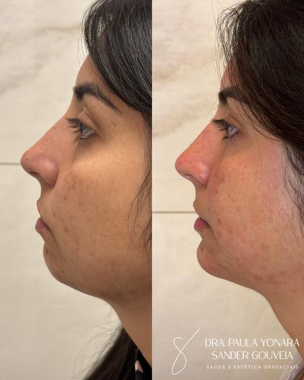 Antes e depois de perfiloplastia