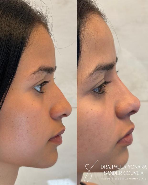 Antes e depois de rinomodelação