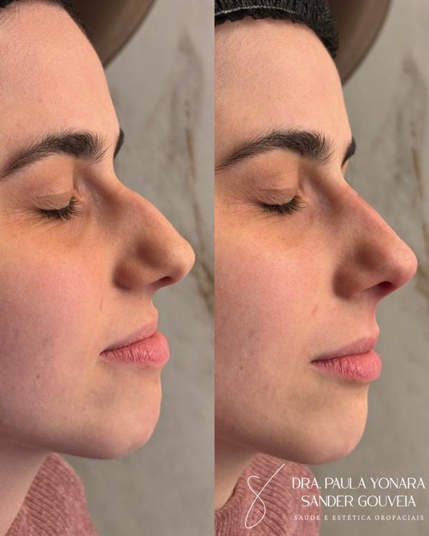 Antes e depois de rinomodelação