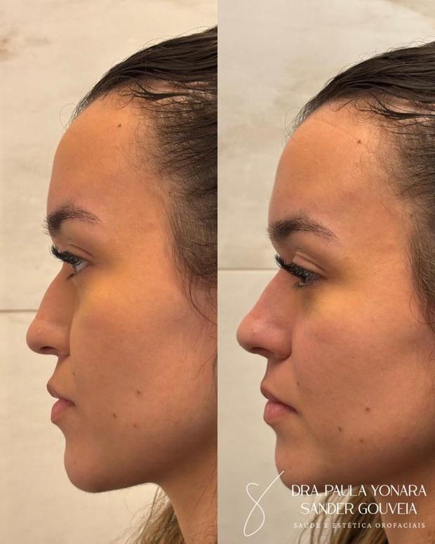 Antes e depois de rinomodelação