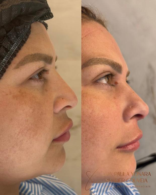 Antes e depois de rinomodelação