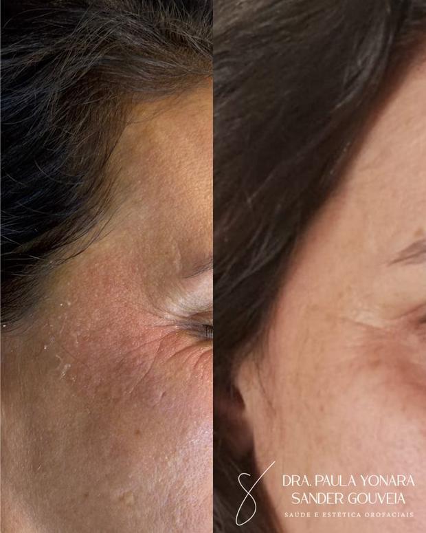 Antes e depois de skinbooster