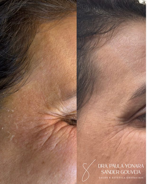 Antes e depois de skinbooster em Paulínia, caso 2 da Dra. Paula Gouveia