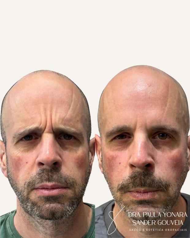Antes e depois de toxina botulínica