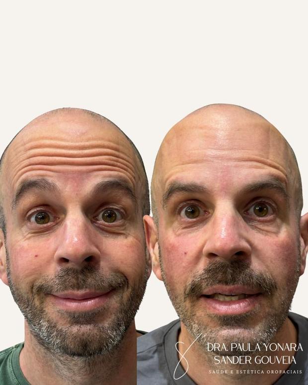 Antes e depois de toxina botulínica