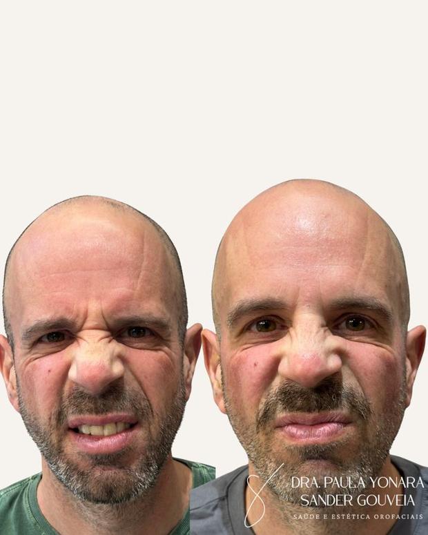 Antes e depois de toxina botulínica