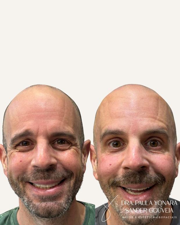 Antes e depois de toxina botulínica